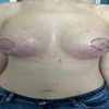 Capezzoli asimmetrici, edema fatti fuoriuscire strizzando il seno