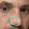 rinosettoplastica fossa sul lato del naso