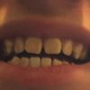 Problema di spaziatura tra i denti (arcata superiore)