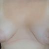 Risoluzione seno tuberoso