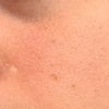 È possibile eliminare le cicatrici da varicella dal viso?