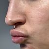 Filler labbra con rigonfiamenti supra labiale