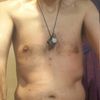 Liposuzione pancia e fianchi