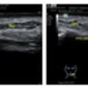 Acido ialuronico e fili pdo 6 d nelle marionette