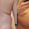 Cellulo Release o Liposuzione tradizionale?