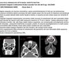 Settoplastica e rinoplastica con ssn