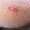 Trattamento cicatrice post rimozione istiocitoma