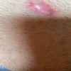 Trattamento cicatrice post rimozione istiocitoma