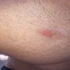 Trattamento cicatrice post rimozione istiocitoma