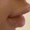 Filler labbra con skinfill Gold plus effetto papera