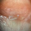 Ptosi severa e diplopia dopo blefaroplastica