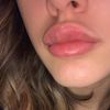 Filler labbra allergia 