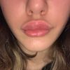 Filler labbra allergia 