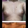 11 gg post mastoplastica dubbi seno più alto e gonfio