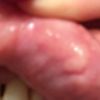 Complicazioni con la filler  labra con Losdeline (aquafilling)