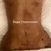 Liposuzione e bbl 1 mese e mezzo fa