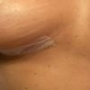 Increspature due settimane post mastopessi
