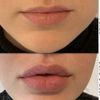 Chirurgia estetica italiana o internazionale - Filler labbra