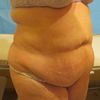 Addominoplastica piu vaser lipo
