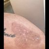 Macchie post laser rimozione tatuaggio 