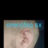 Otoplastica antelice dubbi