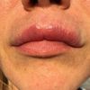 Fibrosi labbro supeiore ed orbicolare
