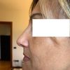 Rinoplastica : naso gonfio e asimmetrico dopo intervento