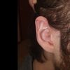Chirurgia plastica elice orecchio destro
