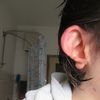 Otoplastica per orecchie malformate