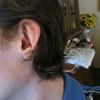 Otoplastica per orecchie malformate