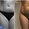 Chirurgia estetica italiana o internazionale? - Liposuzione