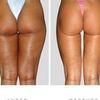 Chirurgia estetica italiana o internazionale? - Liposuzione