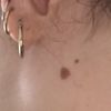 Laser o asportazione chirurgica?
