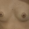 Dubbi per asimmetria mastoplastica