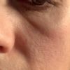 Botox è comparsa piega da occhiaia a guancia