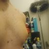 Problemi post ginecomastia e addominoplastica