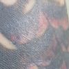 Laser picoway rimozione tattoo e conseguenze croste