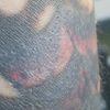 Laser picoway rimozione tattoo e conseguenze croste