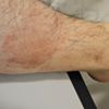 Comparsa di macchie dai piedi al ginocchio