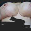 Cicatrici mastopessi e muscoli