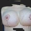 Cicatrici mastopessi e muscoli