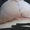 Cicatrici mastopessi e muscoli