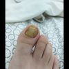 Problema unghie piedi