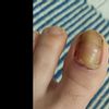 Problema unghie piedi