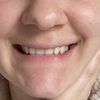 Dopo filler al mento sorriso diverso