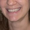 Dopo filler al mento sorriso diverso