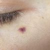 Rimozione angioma stellato