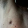 Post operatorio ginecomastia 11 mesi