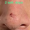 Cicatrizzazione dopo asportazione neo naso