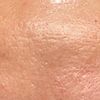 Qualcuno ha avuto notevoli miglioramenti su cicatrici post acne e pori dilatati?